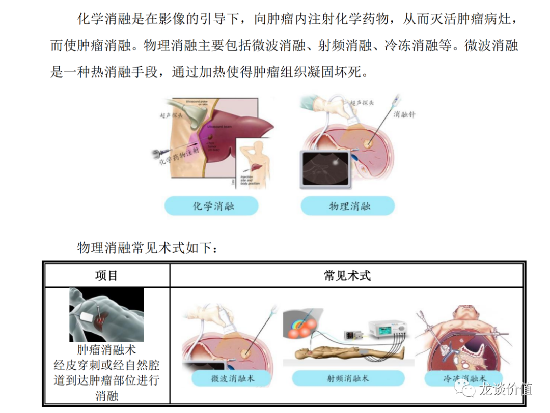 肿瘤消融